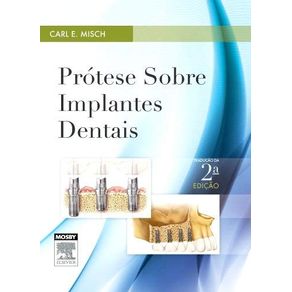 Protese-sobre-implantes-dentais