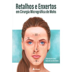 Retalhos-e-enxertos-em-cirurgia-micrografica-de-mohs