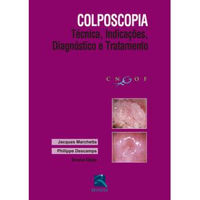 Colposcopia-tecnica-indicacoes-diagnostico-e-tratamento