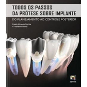 Todos-os-passos-da-protese-sobre-implante